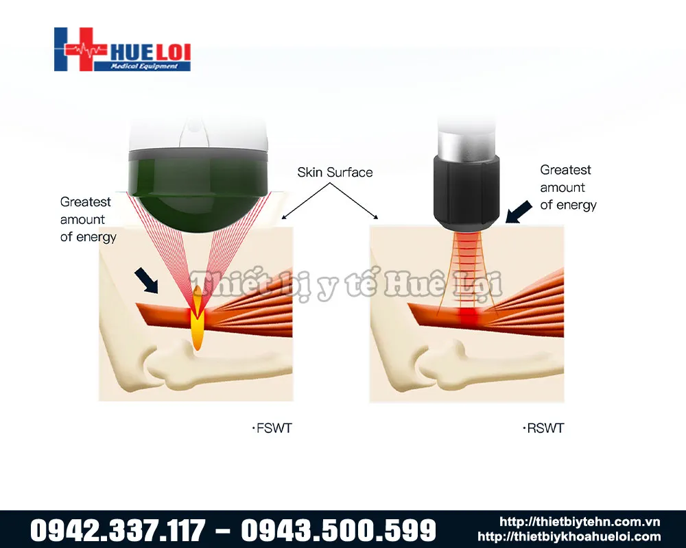 So sánh hai loại máy xung kích trị liệu