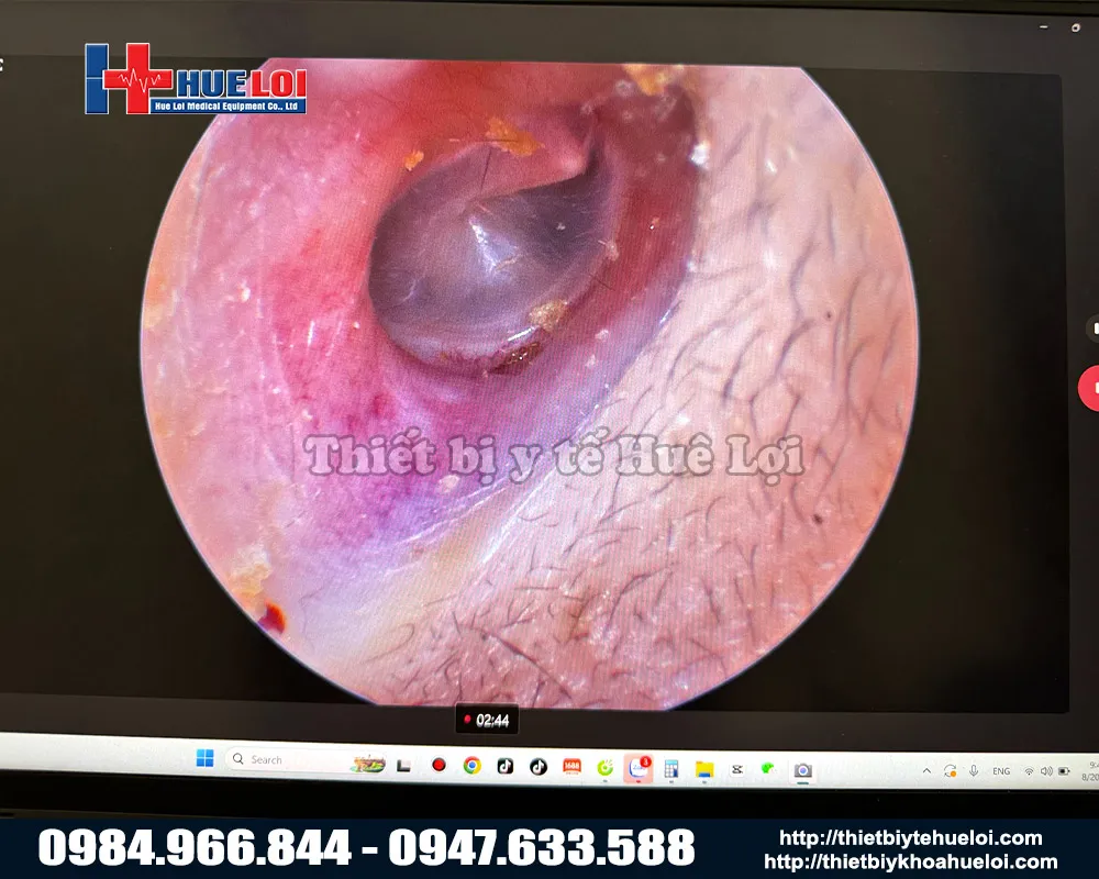 Chất lượng hình ảnh soi tai của máy nội soi tai mũi họng mini