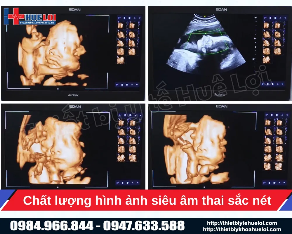 Hình ảnh siêu âm thai nhi bằng máy chẩn đoán hình ảnh cao cấp lx85