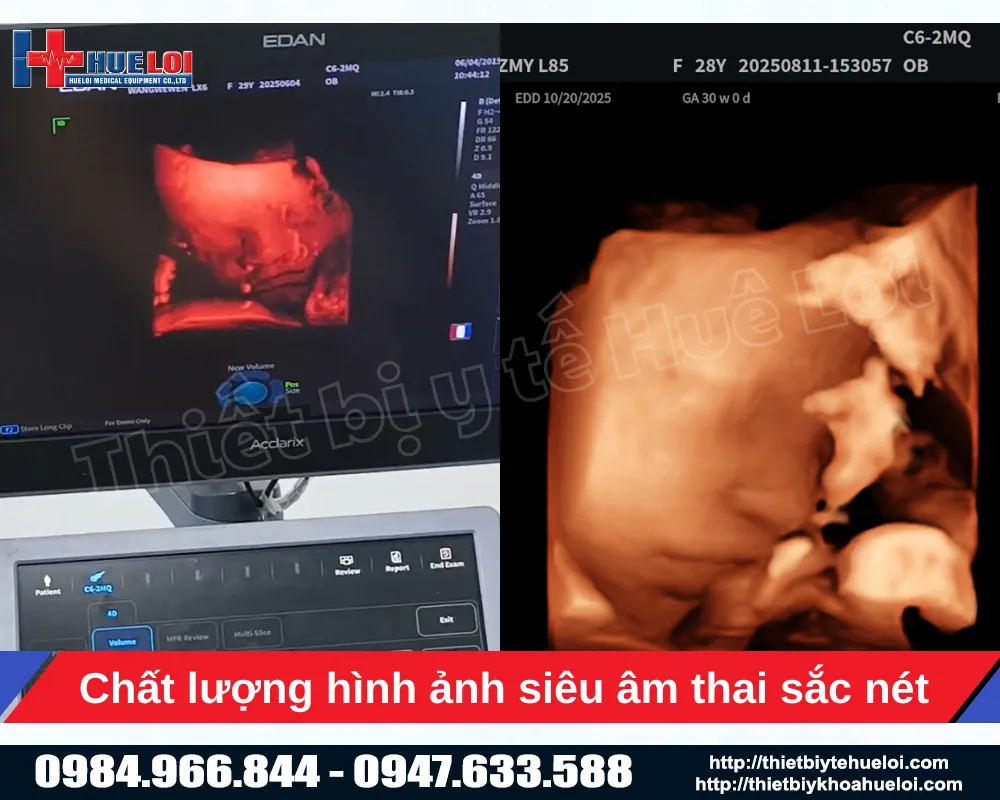 Công nghệ siêu âm 5D ở máy siêu âm bàn đẩy lx85