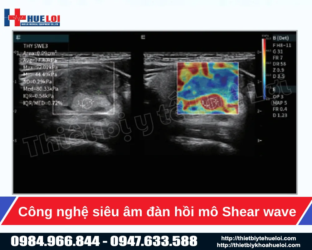 Công nghệ siêu âm đàn hồi mô Shear wave tích hợp trong máy siêu âm Edan Lx85
