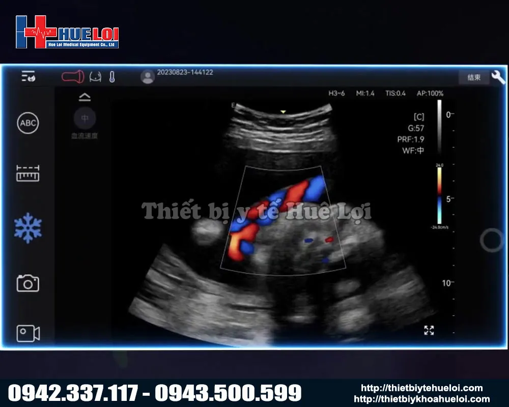hình ảnh thực tế được thực hiện trên máy siêu âm di động edan nano c5 exp