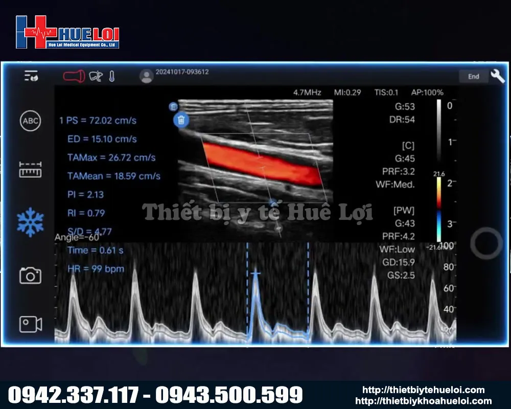 hình ảnh siêu âm của máy siêu âm di đông edan thế hệ mới