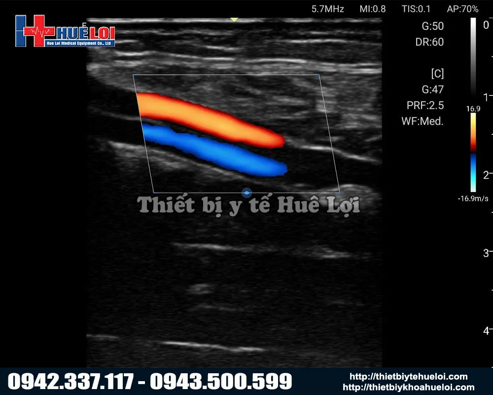 Hình ảnh từ máy siêu âm đầu dò tuyến tính
