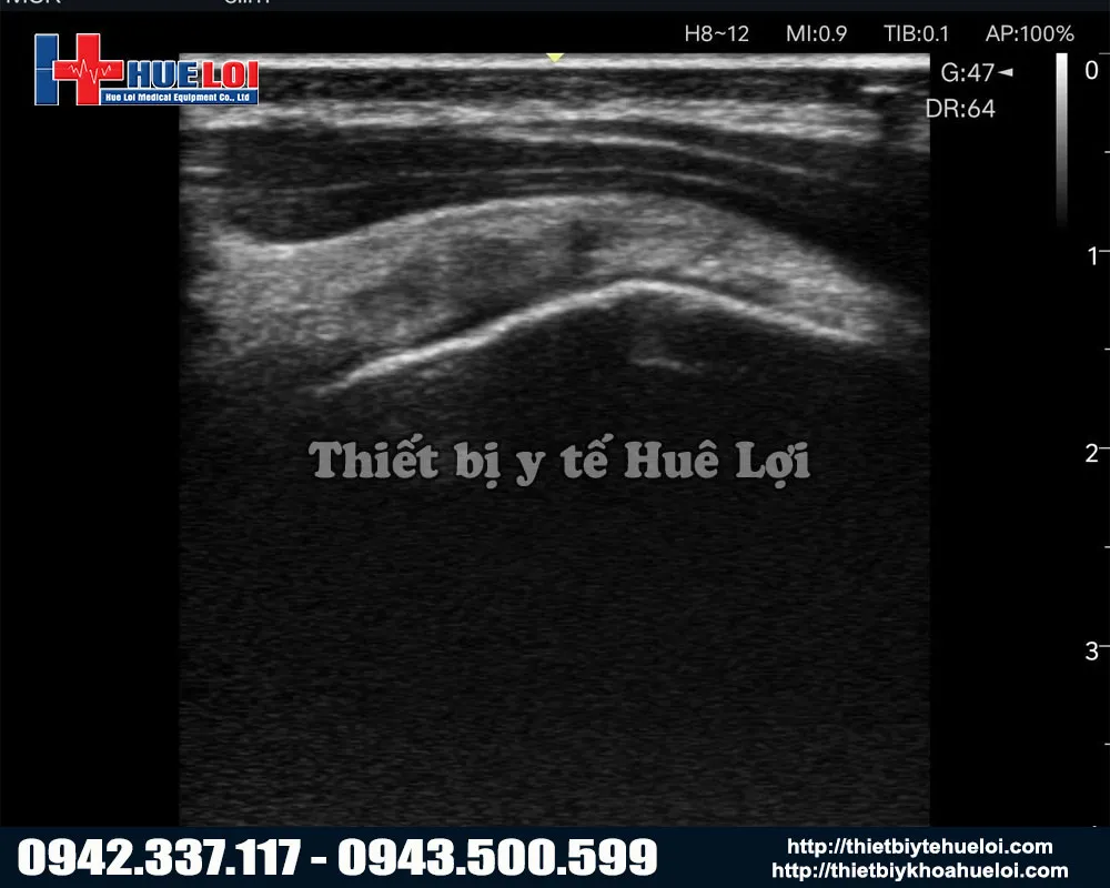 Chất lượng hình ảnh 2d sắc nét từ máy siêu âm xách tay huê lợi