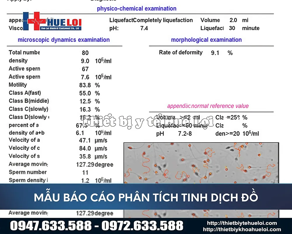 Bảng báo cáo về tinh dịch thông qua máy phân tích dịch đồ