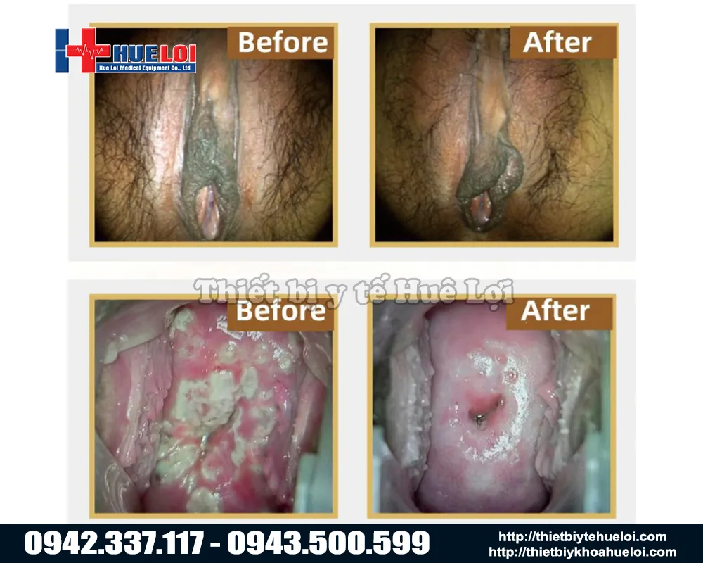 Khác biệt khi điều trị bằng máy phụ khoa sử dụng ánh sáng sinh học