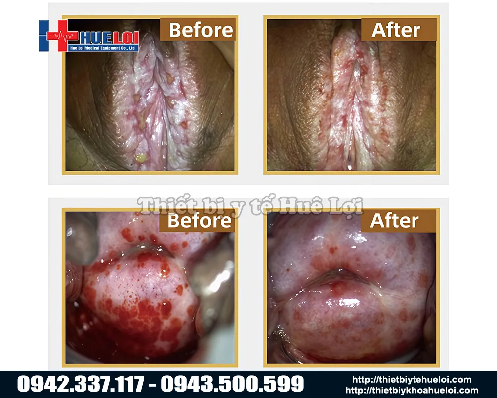 hình ảnh trước và sau khi dùng máy điều trị phụ khoa sw3202