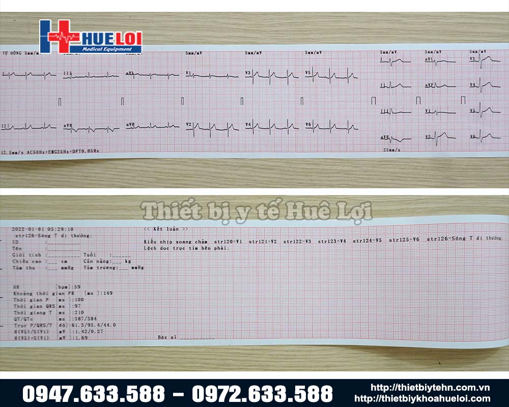 kết quả đọc điện tim