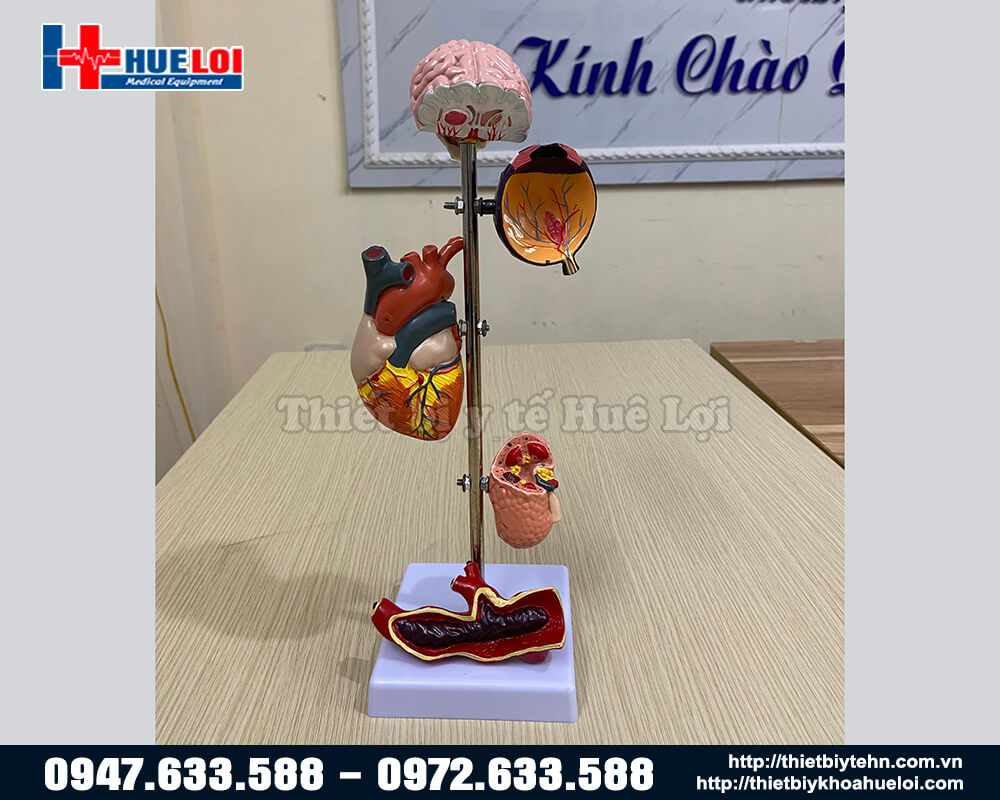 mô hình biến chứng bênh tăng huyết áp